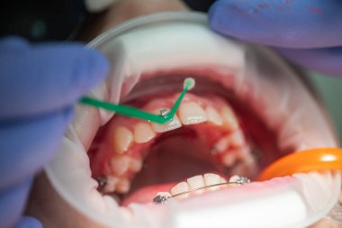 Bir ortodontist hastasının dişlerini dikkatlice ayarlar ve uygun hizayı sağlamak için özel aletler kullanır..