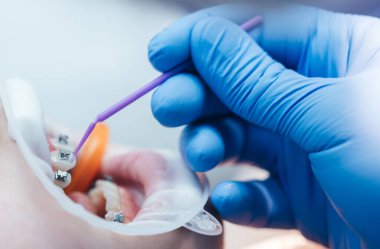 Parlak bir diş muayenehanesinde, yetenekli bir ortodontist hastanın ağzına odaklanır, diş tellerini hassas aletlerle ayarlar. Atmosfer sakin ve profesyoneldir. Tedavi sırasında rahatlık sağlar..