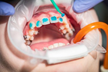 Parlak bir diş kliniğinde, bir ortodontist uygun hizayı sağlamak için hastanın dişlerine özel bir tedavi uygulamaya odaklanır. Prosedür profesyonelliği ve özeni gösteriyor..