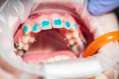 Bir dişçi bir hastanın ağzı üzerinde çalışıyor, parlak mavi malzeme kullanarak diş telleriyle hizalamaya odaklanıyor. Hasta rahatlamış, diş bakımı ve iyileşme sürecine güveniyor..