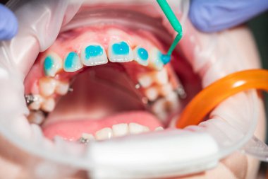 Parlak bir diş hekiminde, bir ortodontist hastanın diş tellerine renkli bir tedavi uygular. Bu odaklanmış prosedür diş hizasını iyileştirmeyi ve hastanın gülümsemesini geliştirmeyi amaçlıyor..