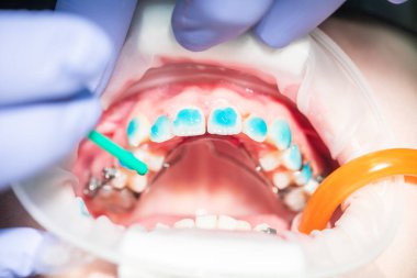 Yetenekli bir ortodontist hastaya nazikçe tedavi uygularken dişlerini ve çenelerini ustalıkla hizalar. Diş tellerinin ve araçların canlı renkleri diş bakımının hassasiyetini vurgular.