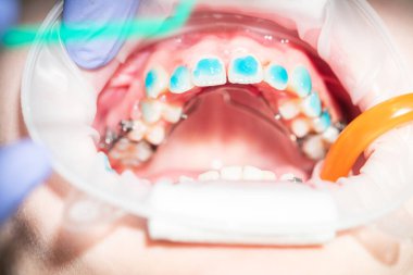 Bir diş kliniğinde, yetenekli bir ortodontist hastanın dişleri üzerinde düzgün hizalanmasını ve diş tellerine uymasını sağlamak için özel aletler kullanarak çalışır ve daha sağlıklı bir gülümseme yaratır..