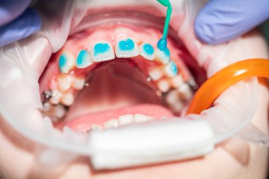 Sıcak bir ortodontik ortamda, yetenekli bir doktor hastanın dişleri üzerinde titizlikle çalışır. Renkli dişçi malzemesi mükemmel hizayı sağlamak ve canlı bir gülümseme yaratmak için dikkatlice uygulanır..