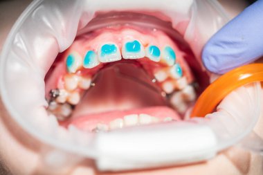 Modern bir ortodonti kliniğinde bir hasta diş hizalama tedavisi görüyor. Ortodontist optimum sonuçlar için diş tellerinin kesin yerleştirilmesi üzerine odaklanır.