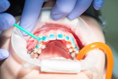 Bir diş kliniğinde, dişçi diş tellerini ayarlamaya odaklanır ve hastaya düzgün diş hizası sağlar. Atmosfer sakin ve profesyoneldir. Tedavi deneyimini geliştirir..