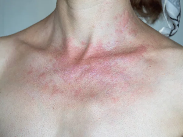 Zonnedermatitis Vrouw Met Rode Gebruinde Huid Tegen Grijze Achtergrond Close — Stockfoto