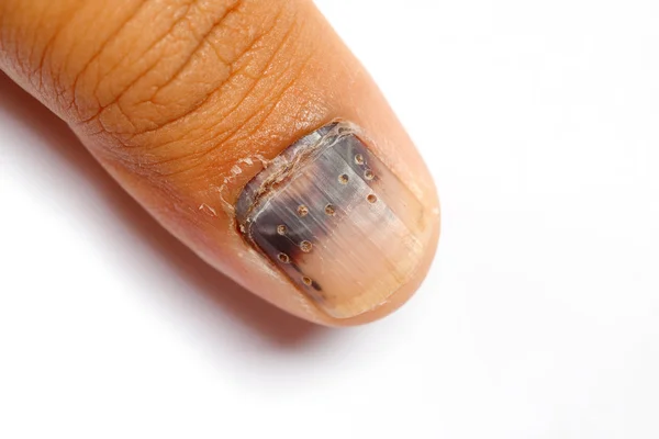 Tirnak alti hematom drenajı