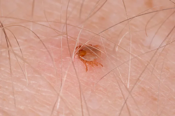 Tick drinking blood biting human skin — Stock Photo, Image