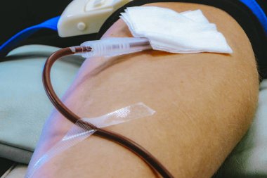 Serum kateteri ve bandajlı bir kolun yakın görüntüsü. Klinik bir ortamda yastıklı bir yüzeye bağlı boruları gösteriyor.