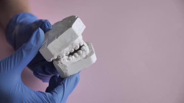 Modello di gesso dei denti prima di installare il sistema di staffa. Medico ortodontista in guanti blu chiude e apre i calchi in gesso della mascella, l'apparato masticante della persona. Vista laterale — Video Stock