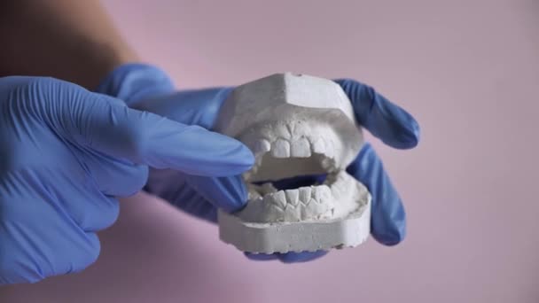 3D-Modell eines Gipsabgusses in den Händen eines Kieferorthopäden. Der Zahnarzt zeigt mit dem Finger auf das Problem mit dem Geschmack des simulierten Mundes — Stockvideo