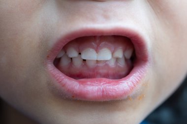 Çocuk Yapay Dişleri Ayarları