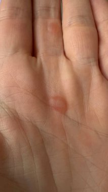 Avuç içlerindeki nasırları kapat..