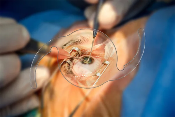 Iol Intraocular Lens Katarakt Oftalmoloji — Stok fotoğraf
