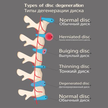 spinal disk dejenerasyon çizimi, eğitici tıbbi illüstrasyon, omurga hastalığı seçenekleri, düz stil, dekorasyon için fikir, vektör imajı