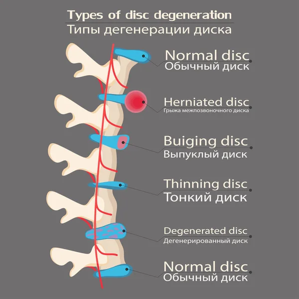Иллюстрация Дегенерации Позвоночника Образовательная Медицинская Иллюстрация Варианты Заболеваний Позвоночника — стоковое фото