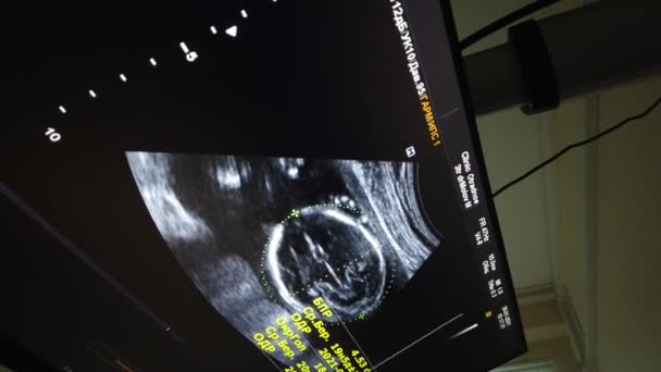 Medical ultrasound scanning, baby silhouette on the screen. Ultrasound scanning, shooting in doctors office. — Stock Video