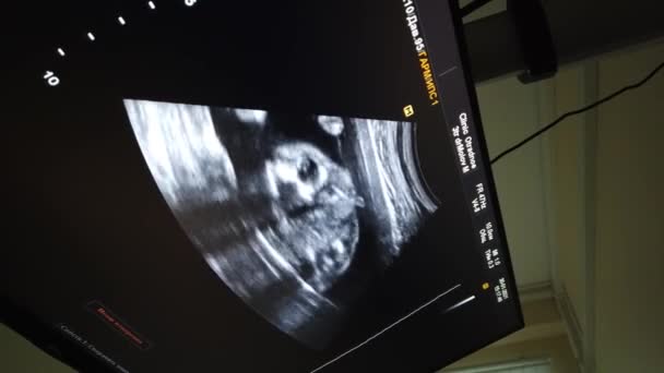 Pemindaian USG medis, siluet bayi di layar. Ultrasound scanning, shooting di kantor dokter. — Stok Video