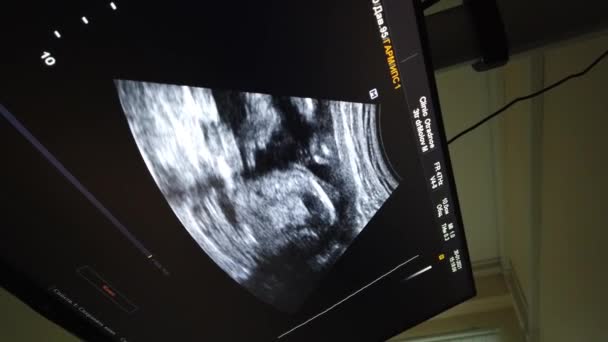 Scansione ecografica medica, sagoma del bambino sullo schermo. Scansione ad ultrasuoni, ripresa nello studio medico. — Video Stock