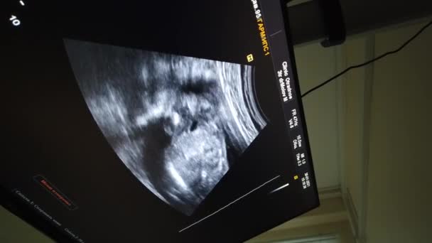 의학 초음파 스캔, 화면에 보이는 아기 실루엣. 초음파 스캐닝, 의사 사무실에서 촬영. — 비디오