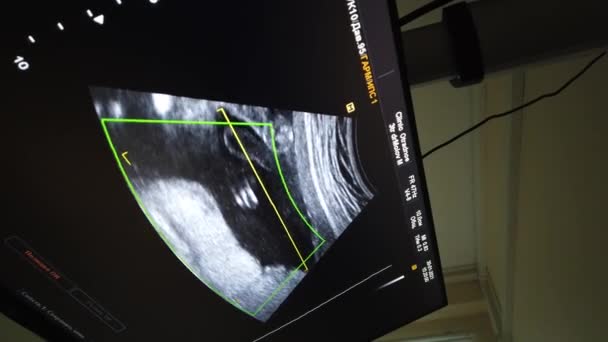 Ultra-sonografia médica, silhueta de bebé no ecrã. Digitalização de ultra-som, tiro no consultório dos médicos. — Vídeo de Stock