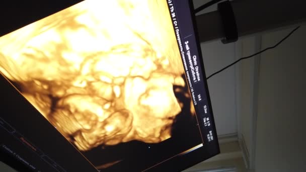 医学超声扫描，婴儿轮廓在屏幕上。超声波扫描，在医生办公室拍摄. — 图库视频影像