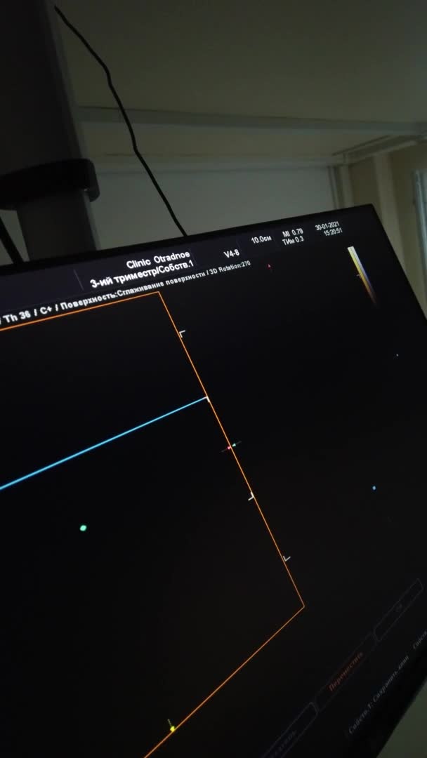 Medicinsk ultraljudsundersökning, silhuett på skärmen. Ultraljudsskanning, fotografering på läkarmottagningen. — Stockvideo