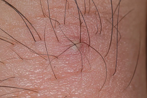 Воспаление Вызванное Вросшими Волосами Большом Пальце Ноги Макрообзоре — стоковое фото