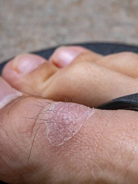 Ayak başparmağındaki derinin iyileşme süreci tüy iltihabından sonra.