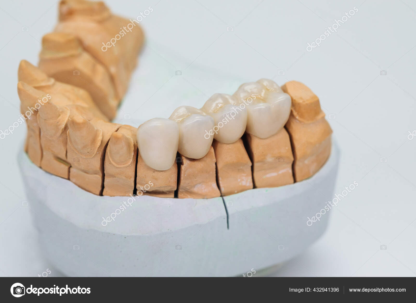 Metal Ceramic Bridge