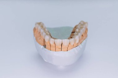 Zirkonyum kaplamaları taçlandırır. Beyaz arka planda izole edilmiş kaplamalı seramik dişler. Alçı modelinde seramik köprü