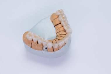 Metal free ceramic dental crowns. Close-up ceramic crowns veneers on a gypsum model. Illuminated glossy look and natural translucency, effect for hollywood smile makeover clipart