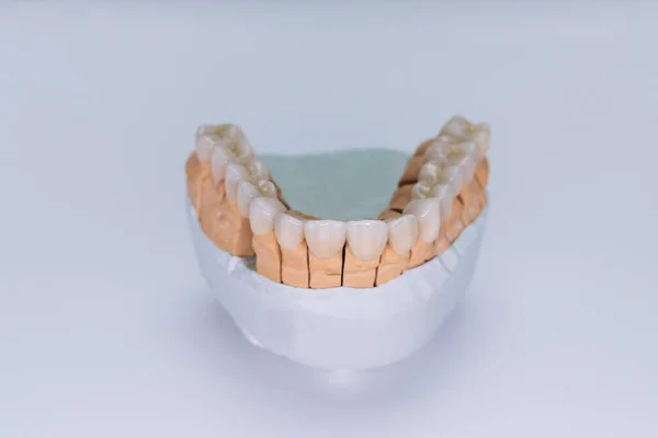 Licówki z cyrkonu. Ceramiczne zęby z okleiną na modelu gipsowym izolowane na białym tle. Most ceramiczny na modelu gipsowym — Zdjęcie stockowe