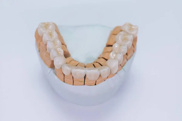 Ceramiczna korona zęba na modelu gipsowym. Wykończono nowe ceramiczne okleiny mostowe na modelu gipsowym. Forniry dentystyczne leżą w laboratorium na dowcipnym tle. — Zdjęcie stockowe
