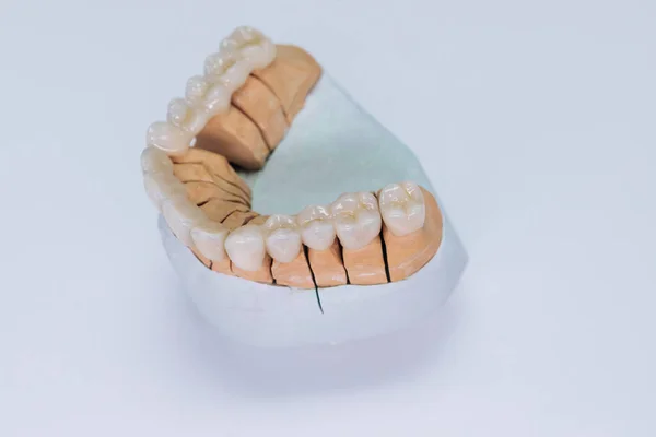 Concept van esthetische tandheelkunde en het ontwerp van fineer. Close-up op gips model van kunstmatige kaak met fineer op de wite achtergrond. — Stockfoto