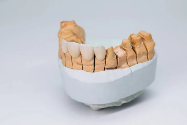 Ceramiczne korony z cyrkonu na jednej szczęce. Ceramiczne korony dentystyczne bez metalu. Fornir dentystyczny na modelu gipsowym. — Zdjęcie stockowe