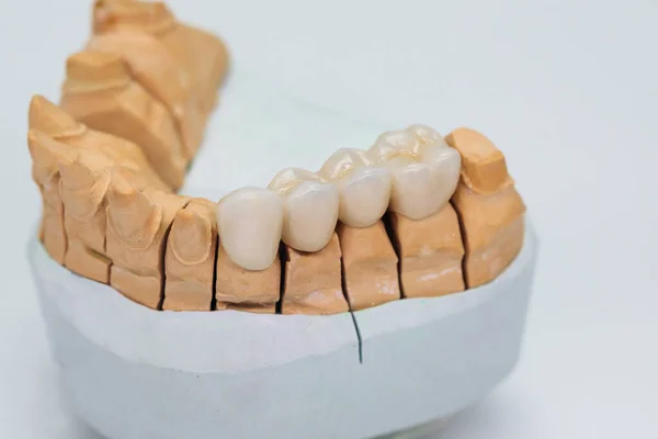 Beyaz arka planda izole edilmiş alçı bir modeldeki metal seramik köprü. Zirkonyum kaplamaları taçlandırır. Kaplamalı seramik dişler.