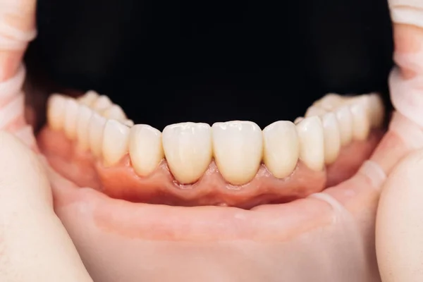 Keramische kronen van menselijke tanden close-up macro. Het concept esthetische tandheelkunde. Zirkonia brug met porselein. Mooie vrouwelijke tanden macro fineer — Stockfoto
