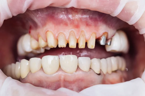 Teeth during dental treatment. Close-up. Dentistry. Patient at the dentist office. Female teeth macro zirconium. Closeup photo with zirconium artificial teeth. Zirconia bridge with porcelain. — Stock Photo, Image