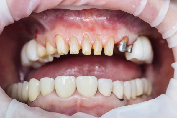 Close-up Tandheelkundige Patiënt bij de tandarts. Vrouwelijke tanden macro zirkonium. Close-up foto met zirkonium kunsttanden. Zirkonia brug met porselein — Stockfoto