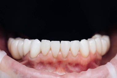 Saplantıdan sonra pervaneler. Doğal renk. Kozmetik diş kaplamaları. Diş sağlığı kliniğindeki kaplamaların modern diş donanımı ve kurulum prosedürü