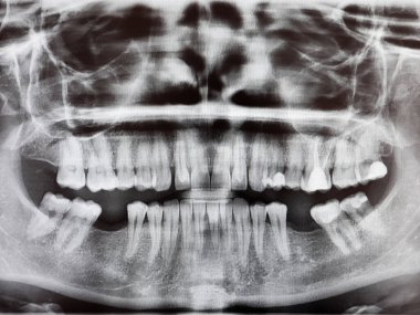 Panoramik diş röntgeni yetişkin dişlerini ve çene yapısını gösteriyor. Yüksek kalite.