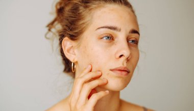 Cilt kusurları olan genç bir kadının yakın çekimi parlak bir odadaki küçük bir aynaya bakar. Güzel bir kadın kapalı alanda lekelerine dokunur. Sivilce kavramı, dermatoloji.