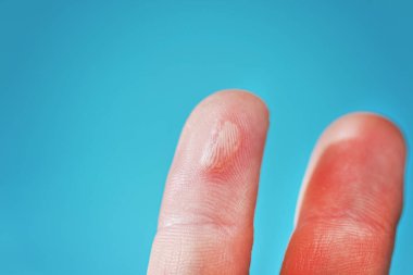 İnsan elinin orta parmağında nasır var.