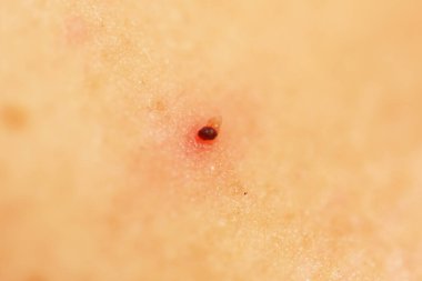 Boynuna doğum lekesi asarken yaralanmış..