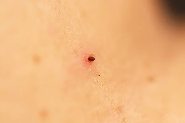 Secado lesionado colgando una marca de nacimiento en el cuello. — Foto de Stock