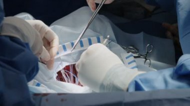 Bir açık kalp ameliyatı sırasında cerrahlar
