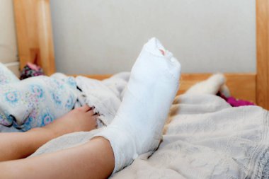 The girl has a broken leg. Woman resting at home in bed after medical treatment. Human leg in a cast on the bed. clipart