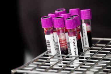 Close up of blood samples in test tubes with purple caps arranged in a metal rack at a laboratory. Medical analysis and health testing concept for diagnosis, research, and clinical examination.
